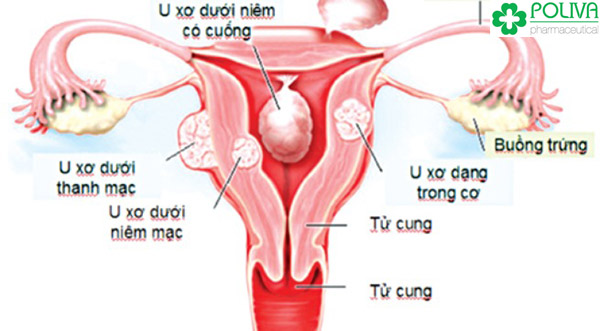 Các loại u xơ tử cung thường gặp.
