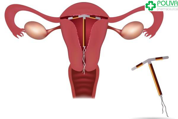 Vòng tránh thai IUD là một phương pháp ưu việt