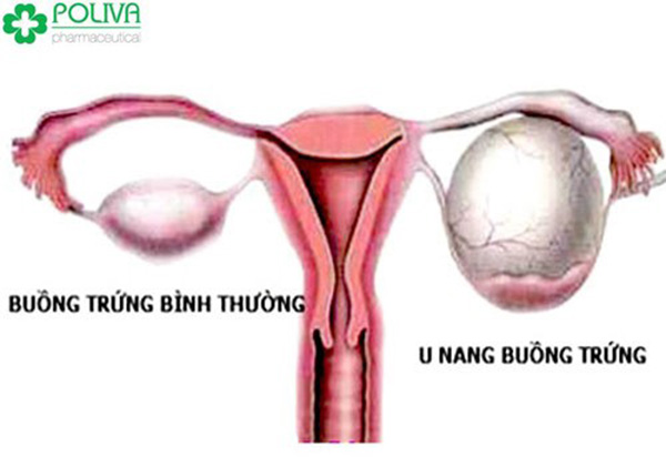 Bệnh phụ khoa thường gặp