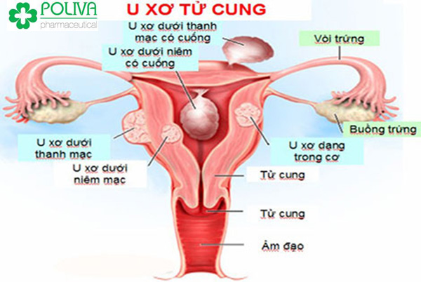 Các bệnh phụ khoa thường gặp
