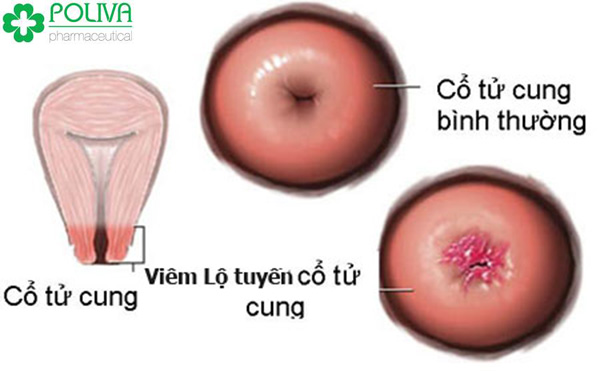 Bệnh viêm lộ tuyến tử cung