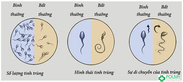 Tinh trùng ở trạng thái bình thường và tinh trùng dị dạng