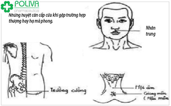 Xử lý thượng mã phong chỉ bằng một cây kim nhỏ