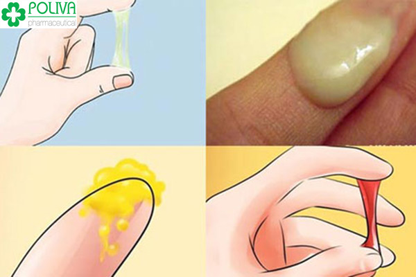 Các màu sắc chứng tỏ đang mắc bệnh huyết trắng