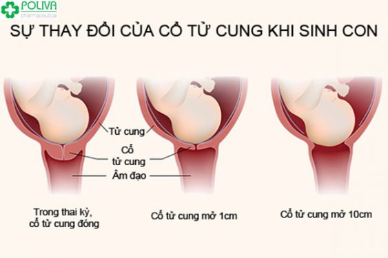 Sự thay đổi của cổ tử cung để chuẩn bị cho quá trình sinh nở