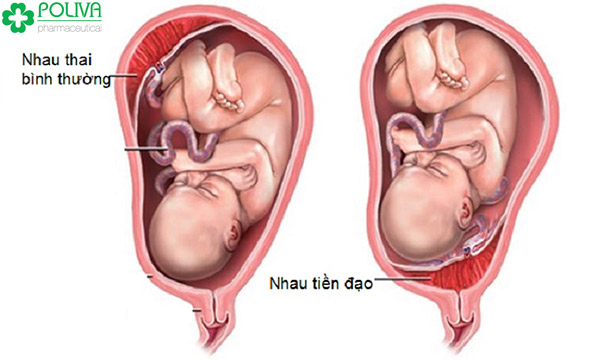 Nhau tiền đạo là một biến chứng quan ngại, đáng lo khi mang thai