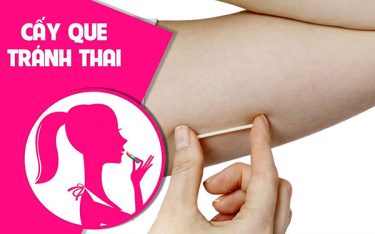 Que cấy tránh thai là gì, liệu có an toàn khi dùng không?
