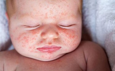 Trẻ bị sốt phát ban tắm lá gì để nhanh khỏi bệnh?