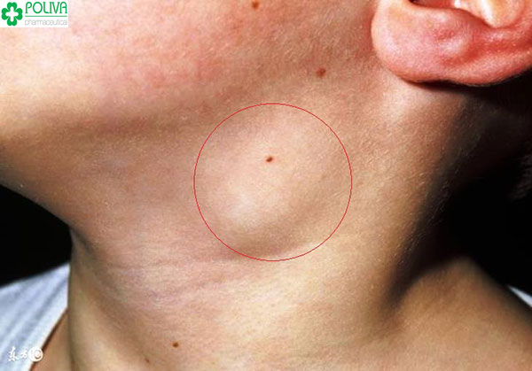 Sưng hạch bạch huyết ở vùng cổ, nách có thể do nhiễm virut HIV gây nên