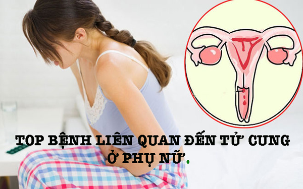 Top 5 bệnh ở tử cung phụ nữ nguy hiểm khó lường